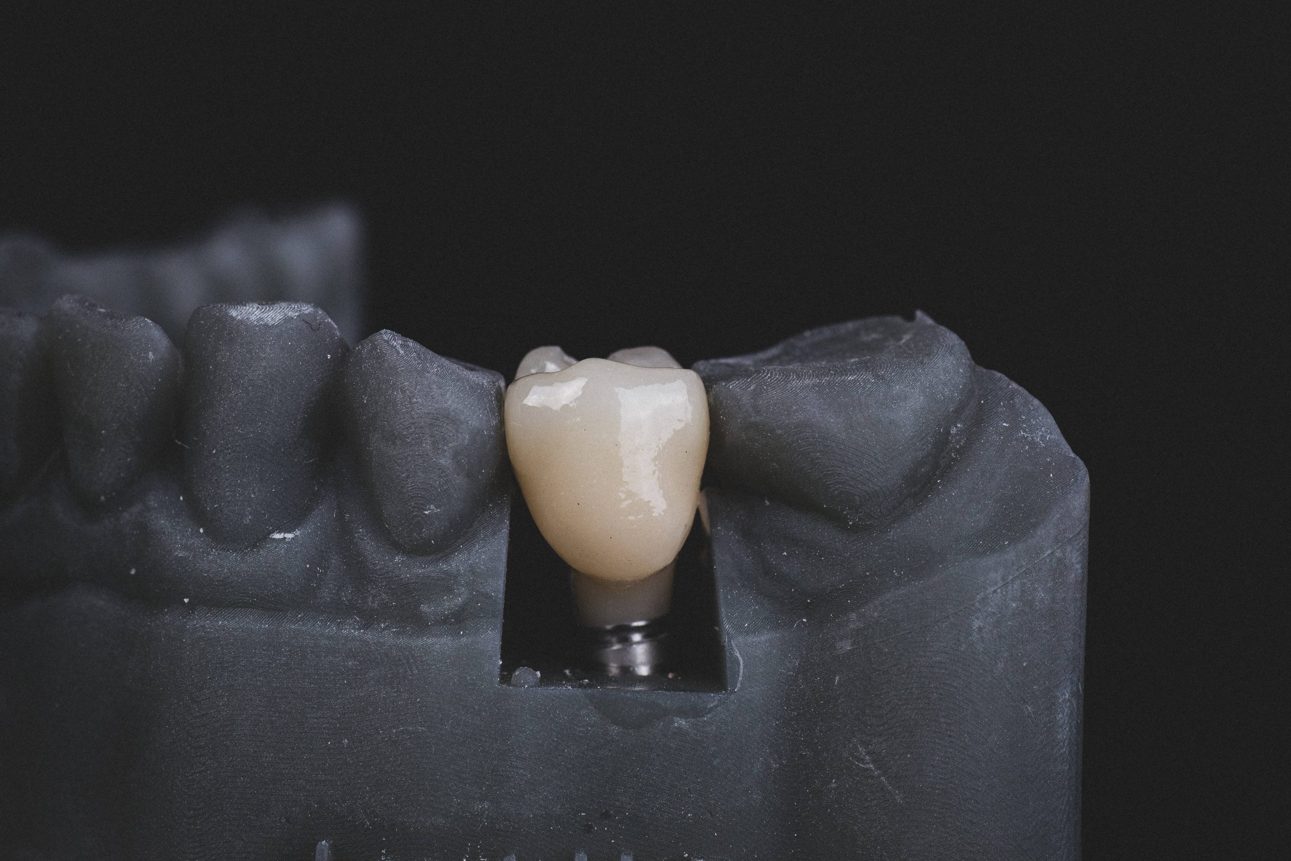 Andalusia Same-Day Dental Crowns (CEREC)